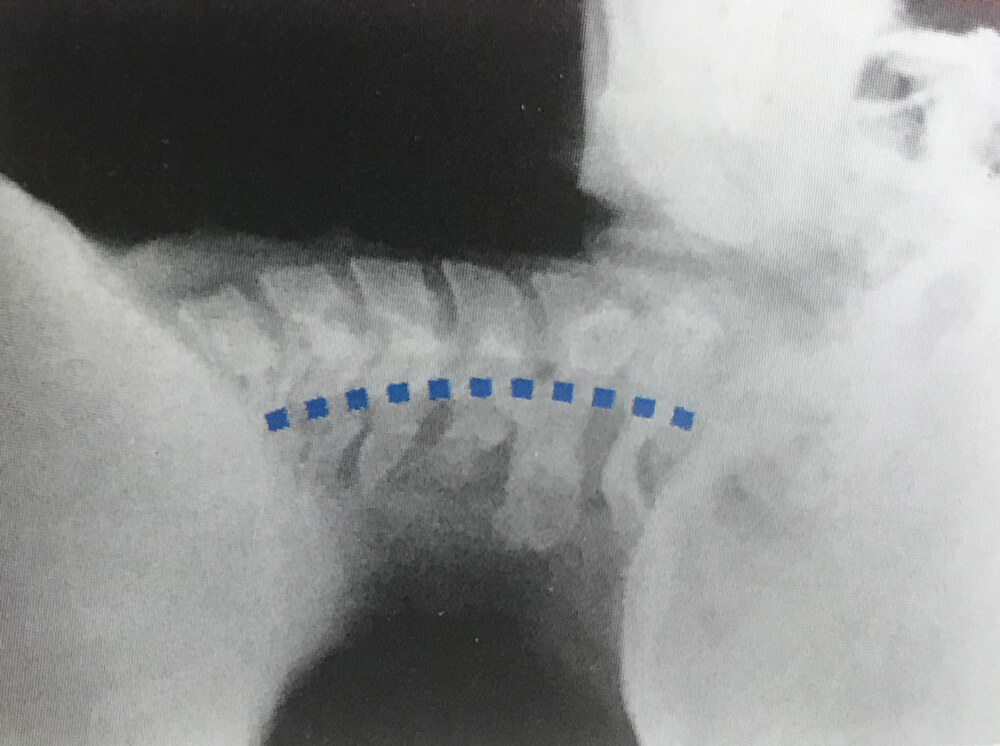 自然なカーブの頸椎