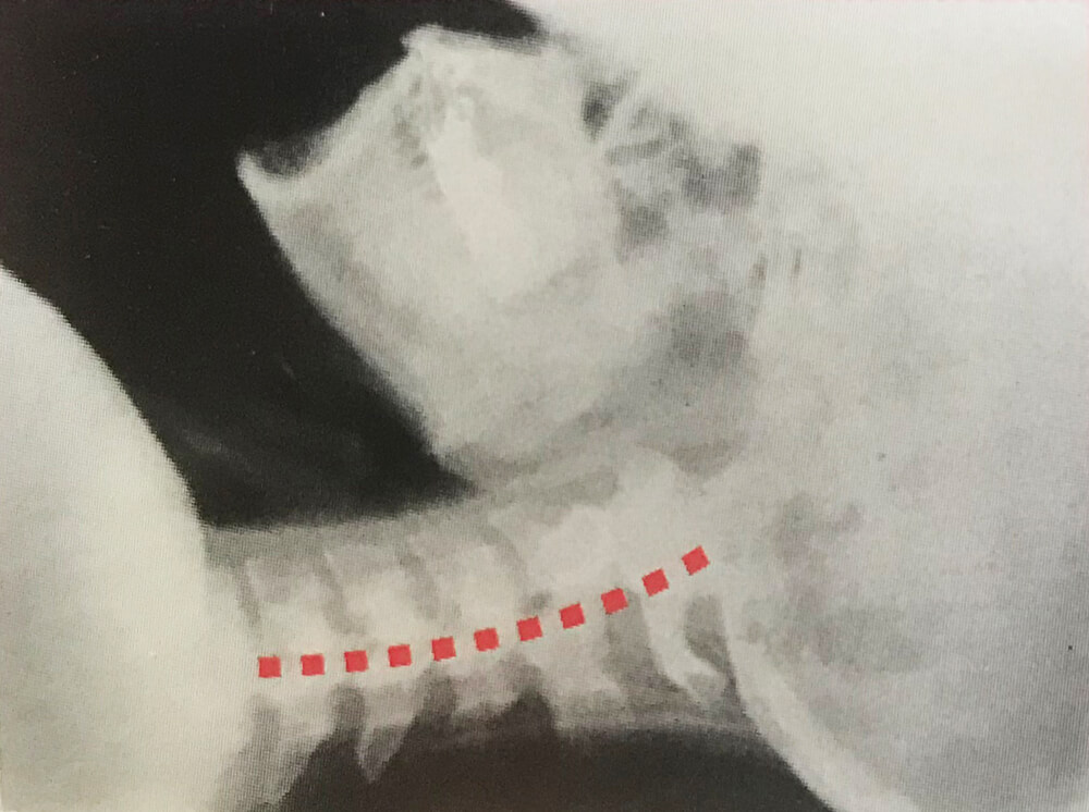 不自然なカーブの頸椎